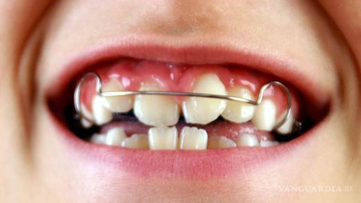 <strong>Tìm hiểu về niềng răng cửa | Thetips</strong>