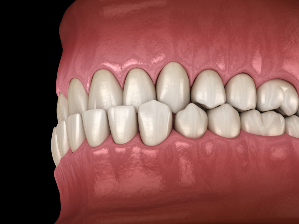 Niềng răng trong suốt hoạt động như thế nào?
