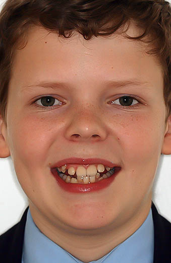 Niềng răng tại Total Orthodontics, ảnh trước và sau