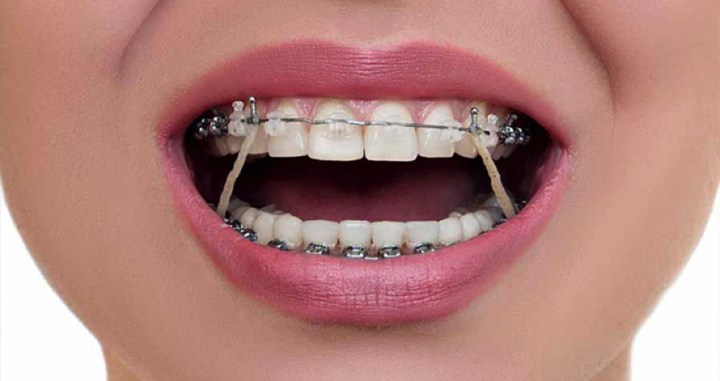 Lợi ích của việc nẹp răng là gì? Tìm hiểu các phương pháp nẹp răng