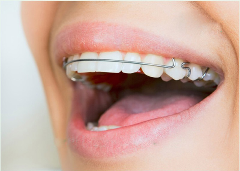 Thế nào là niềng răng hô? Tìm hiểu các vấn đề thường gặp