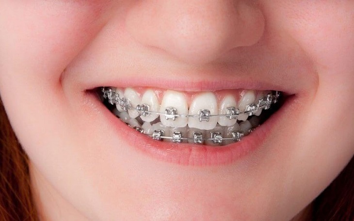 <strong>5 nguyên nhân khiến răng hô bạn nên biết</strong>