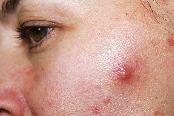 Mụn viêm xuất hiện trên da do nhiều nguyên nhân khác nhau