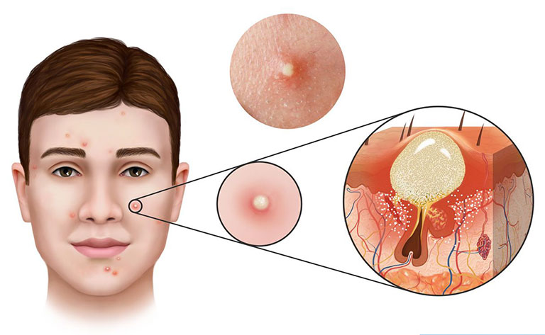 Mụn bọc xuất hiện chủ yếu do da bị nhiễm khuẩn P.acnes ở nang lông
