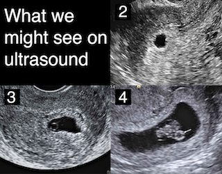 Hình ảnh siêu âm 4 giai đoạn đầu thai kỳ
