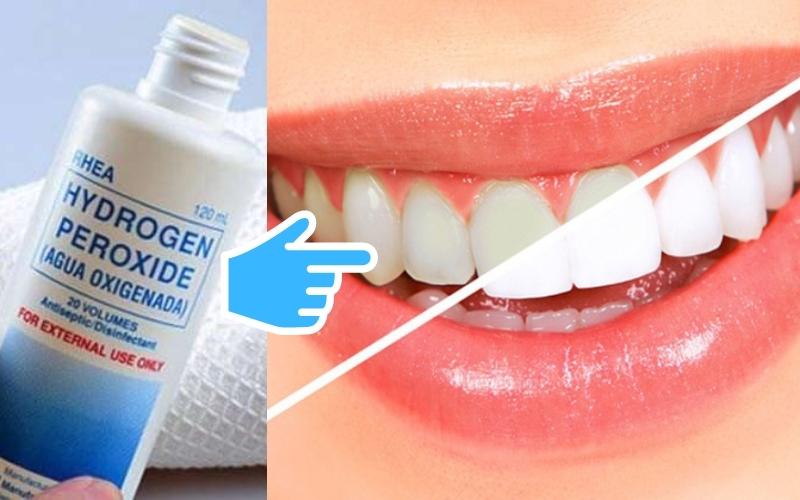 Bí quyết tẩy răng hết ố vàng hiệu quả bằng oxy già