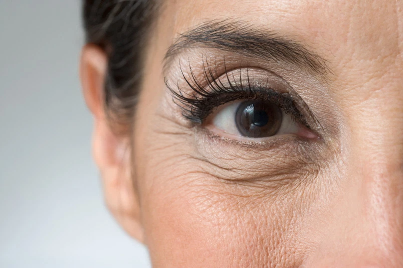 Những cách làm giảm nếp nhăn ở mắt hiệu quả và an toàn nhất