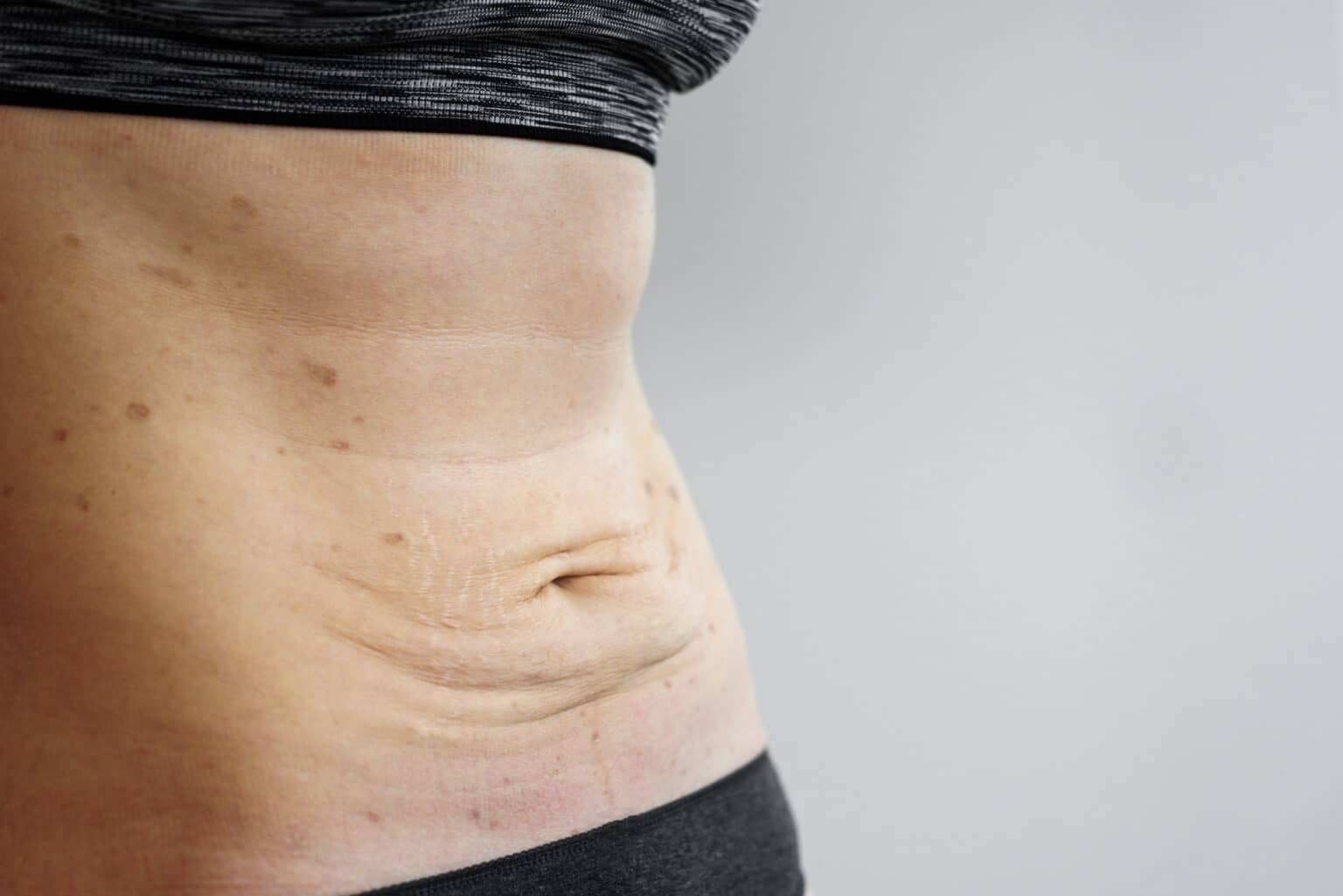 Tình trạng da bụng chảy xệ sau giảm cân: Nguyên nhân và Biện pháp khắc phục
