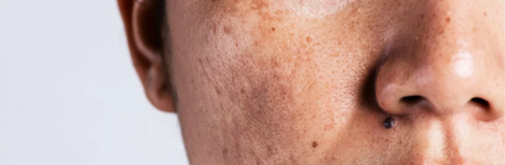 Tăng sắc tố sau viêm (PIH) là một trong những nguyên nhân gây nám da mặt ở vùng má