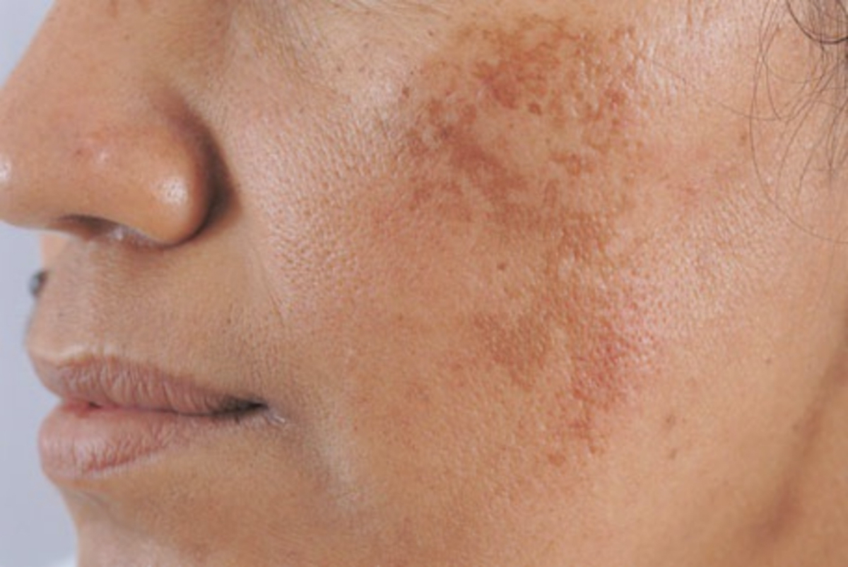 7 nguyên nhân gây nám da mặt vùng má