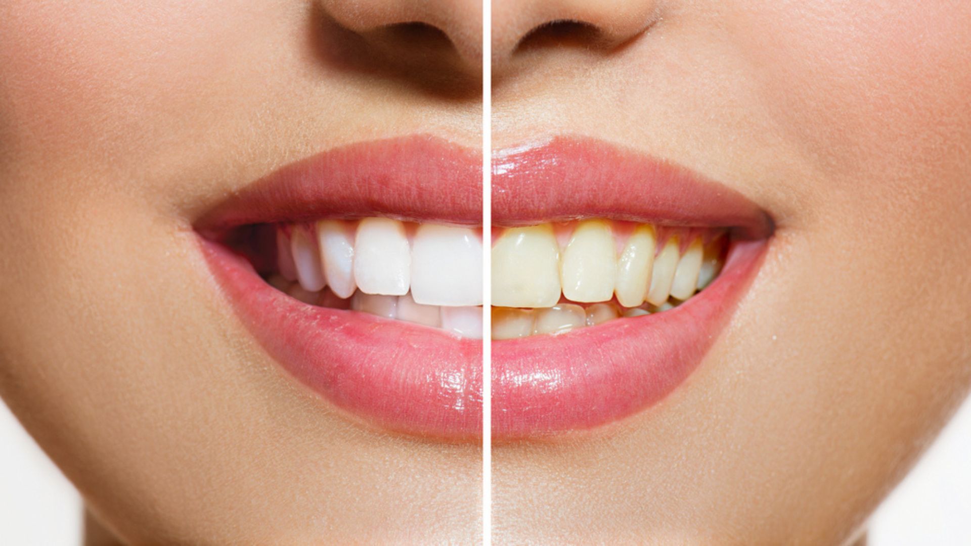 Bật mí cách làm trắng răng tại nhà an toàn, hiệu quả, dễ thực hiện