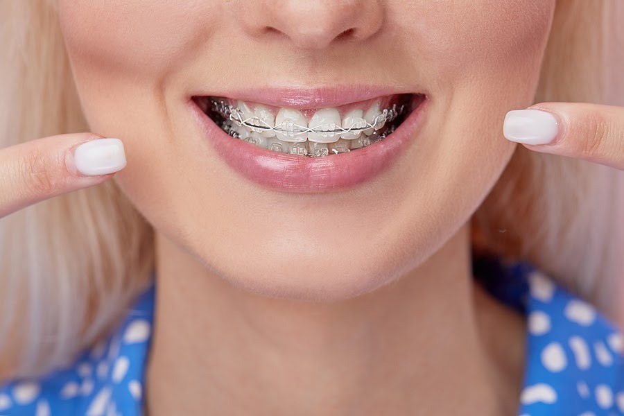 Niềng răng có tốt không? Niềng răng giúp chống sâu răng và các bệnh về nướu răng - Ảnh 2