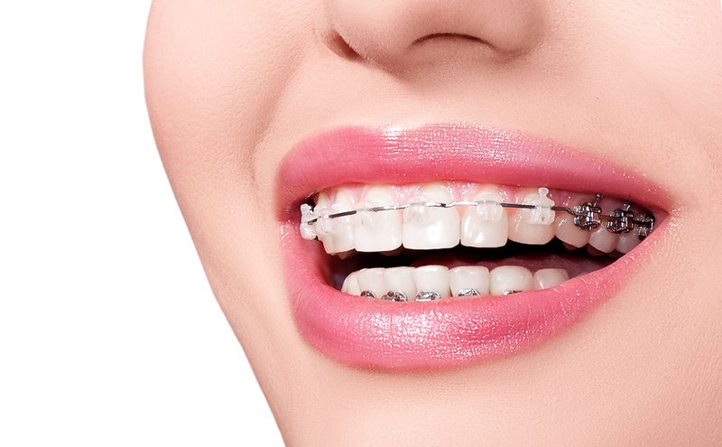 Niềng răng có lợi ích gì? Những điều cần biết khi niềng răng