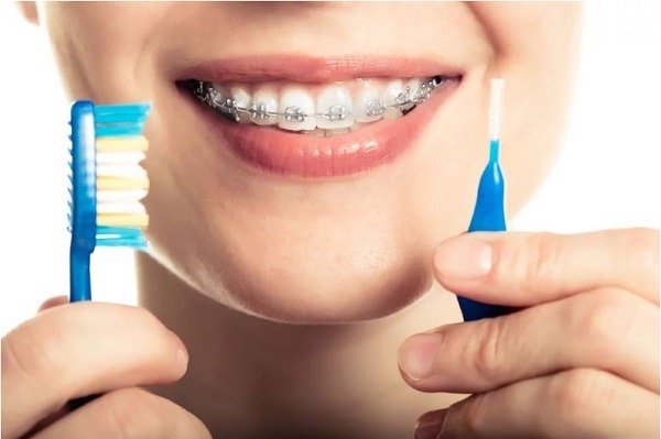 Vệ sinh răng miệng sau mỗi bữa ăn khi niềng răng thẩm mỹ - Ảnh 2
