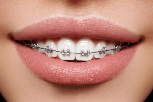 Niềng răng có đau không sau quá trình niềng răng - Ảnh 2