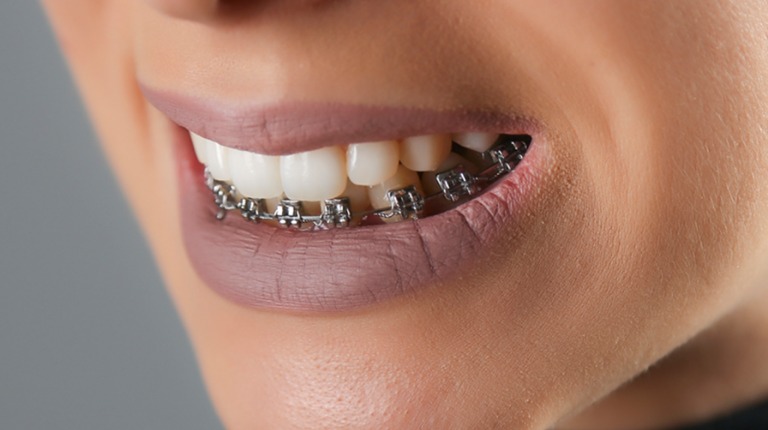 Niềng răng hàm dưới có tốt không và các phương pháp niềng