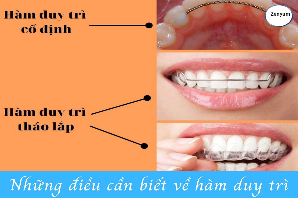 Những điều bạn cần biết về hàm duy trì sau khi niềng răng - Ảnh 2