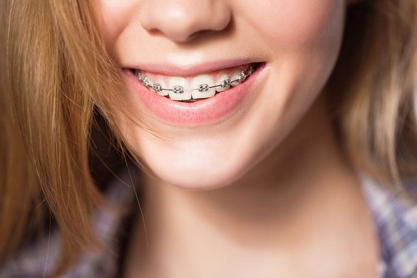 Tại sao bạn nên cân nhắc điều trị niềng răng - Ảnh 6