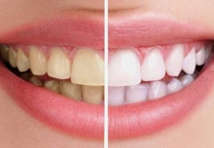 7 Nguyên nhân khiến hàm răng bị ố vàng mất tự tin