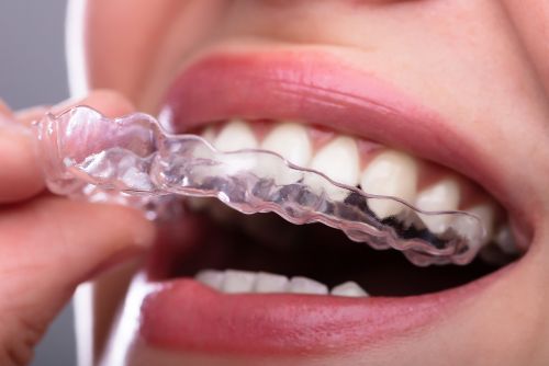 Điều trị niềng răng 1 hàm có thể gây ra các vấn đề về vết cắn - Ảnh 3