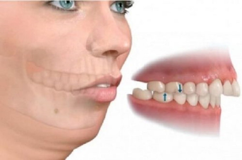 Thói quen dẫn đến tình trạng răng hô - Ảnh 3