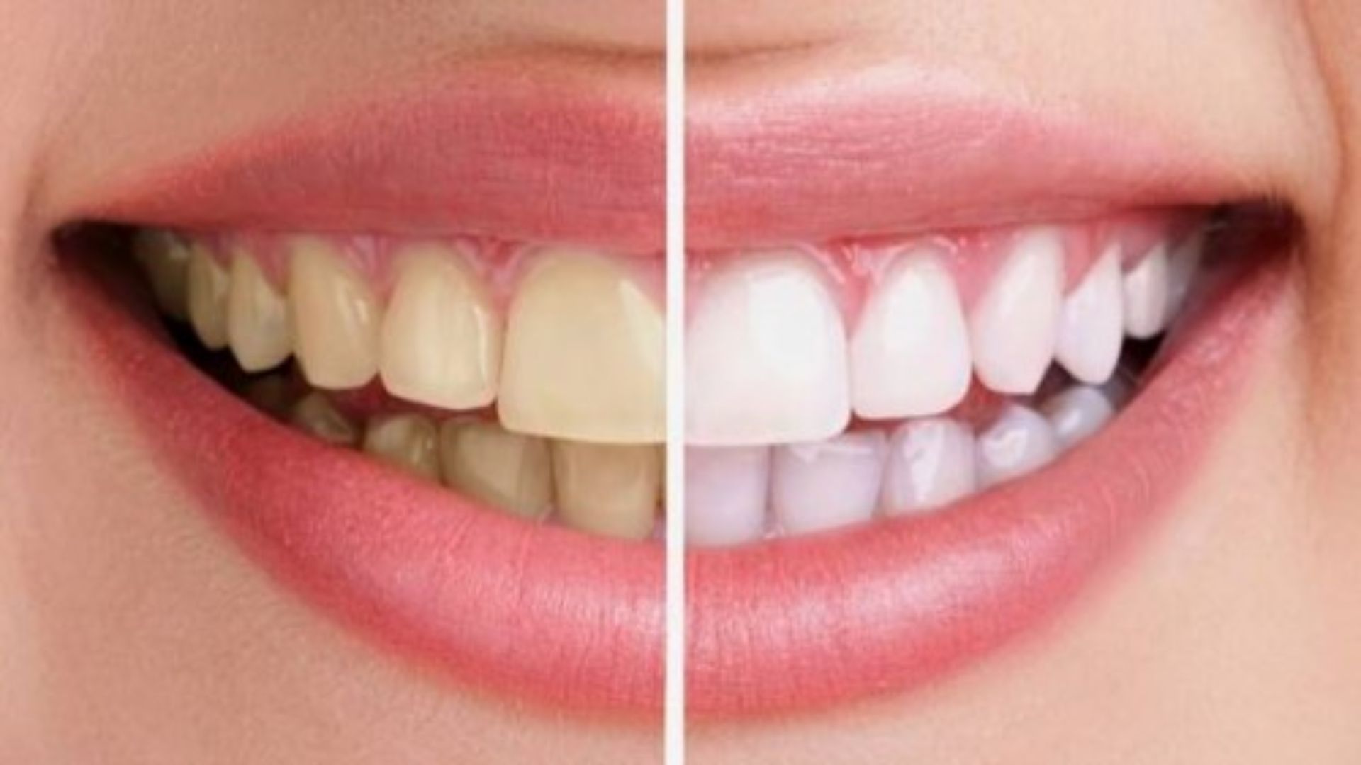 Đâu là tác hại khi sử dụng bột trắng răng sai cách?