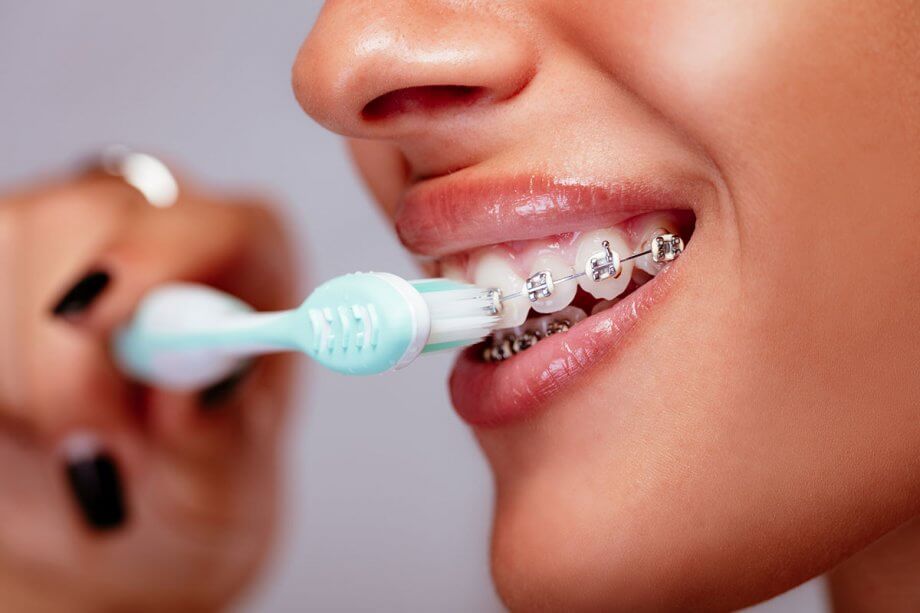  Vì sao cách chăm sóc răng miệng khi niềng răng lại quan trọng? - Ảnh 1