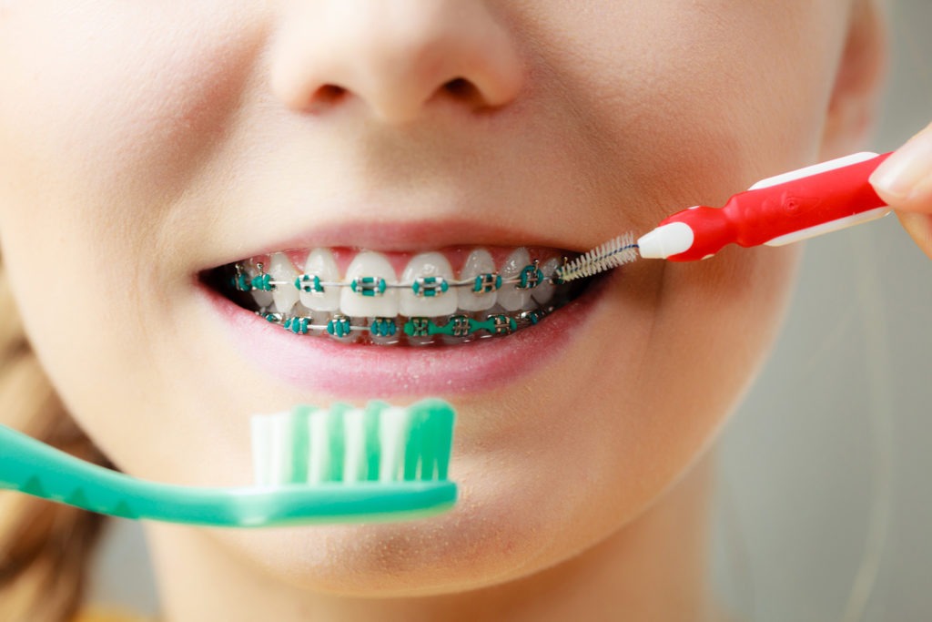 Các cách chăm sóc răng miệng khi niềng răng: Đánh răng & dùng chỉ nha khoa - Ảnh 3