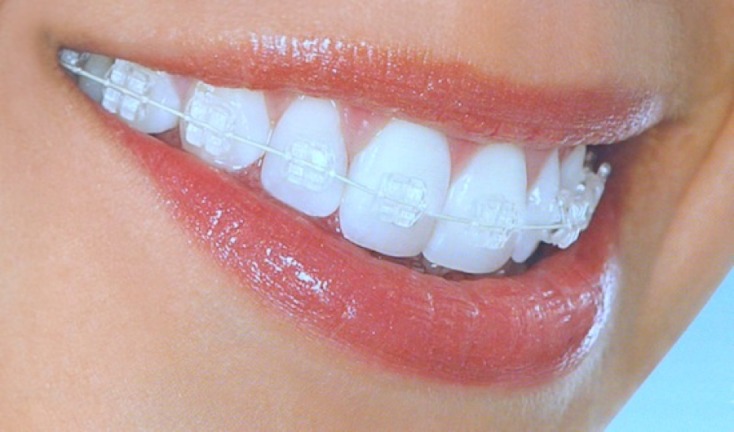 Niềng răng 1 hàm là gì? - Ảnh 1