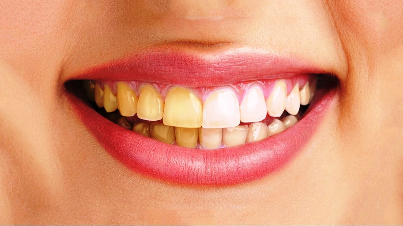 Lý do răng bị ố vàng?