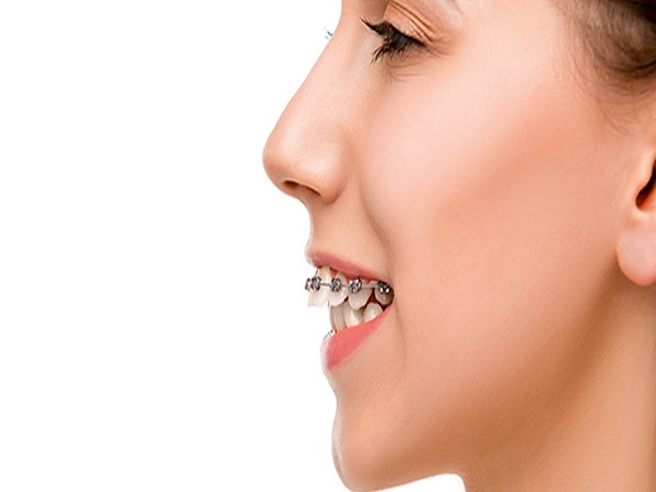 Điều trị răng hô với niềng răng - Ảnh 3