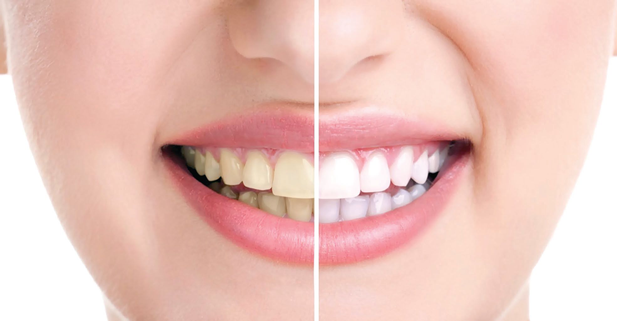 Nghe thiệt lạ nhưng là sự thật, quả cau có thể giúp làm trắng răng hiệu quả