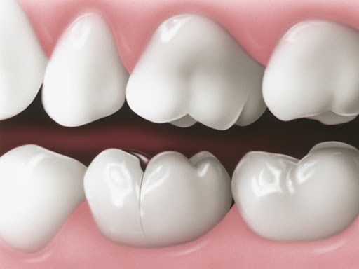 Hậu quả của việc bọc răng sứ