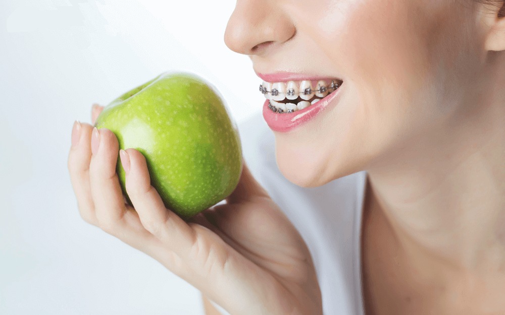 Thực phẩm nên tránh khi niềng răng - Ảnh 4