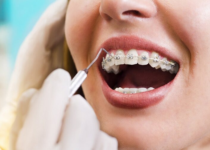 Cách chăm sóc răng miệng trong quá trình niềng răng - Ảnh 5