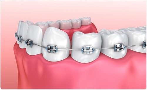 Các phương pháp niềng răng hàm dưới - Ảnh 2