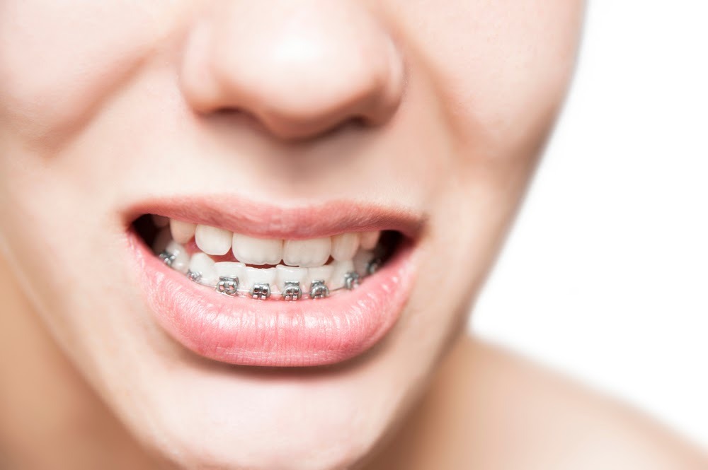 Niềng răng 1 hàm ở hàm dưới - Ảnh 2