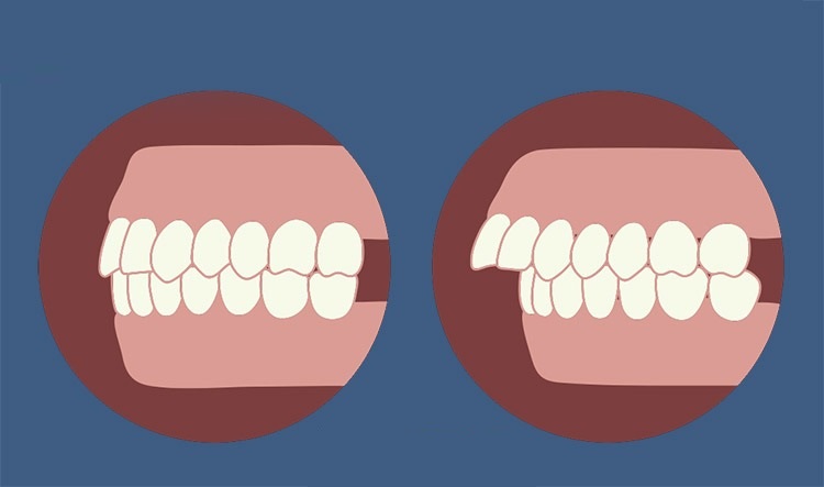 Nguyên nhân gây tình trạng răng hô - Ảnh 2