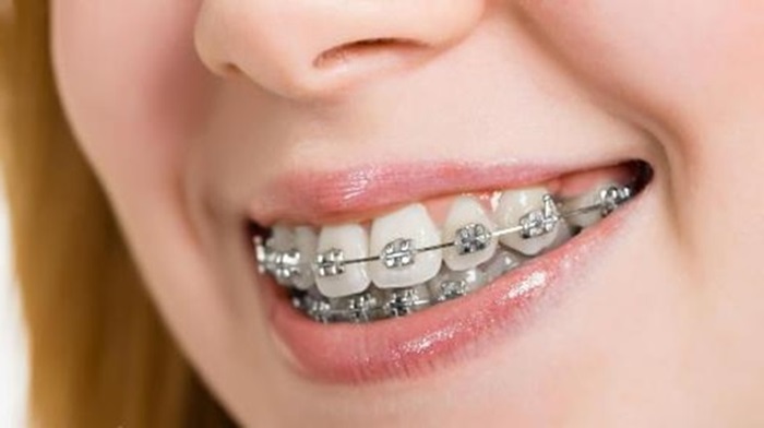 Răng hô: Nguyên nhân, chi phí niềng răng hô nhẹ mới nhất