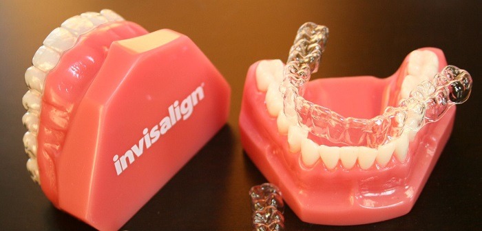 Niềng răng hàm dưới có các rủi ro nào? - Ảnh 2
