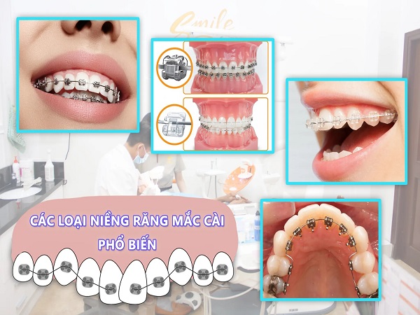 Phương pháp niềng răng móm - Ảnh 3
