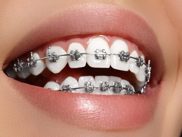 Mua bảo hiểm nha khoa để tiết kiệm chi phí niềng răng - Ảnh 2