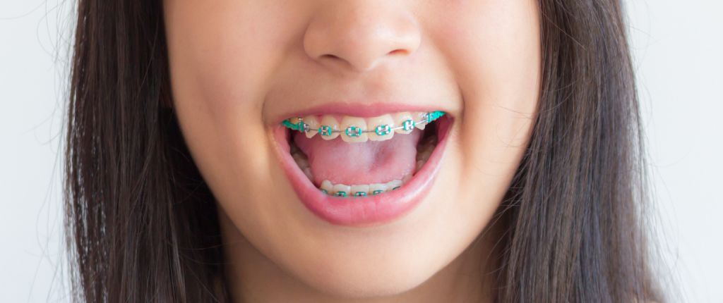 8 mẹo làm sạch niềng răng thẩm mỹ để có hàm răng khỏe mạnh và nụ cười rạng rỡ