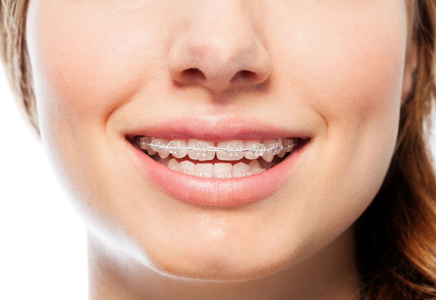 Làm thế nào để ngăn chặn cơn đau khi niềng răng - Ảnh 5