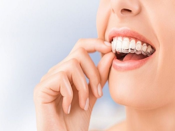 Invisalign có khắc phục được tình trạng răng hô không? - Ảnh 3