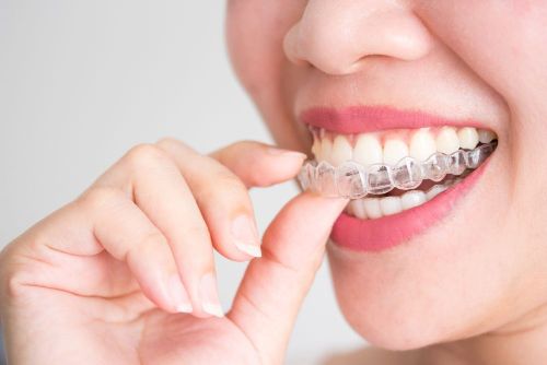 Niềng răng là gì? 6 phương pháp niềng răng phổ biến