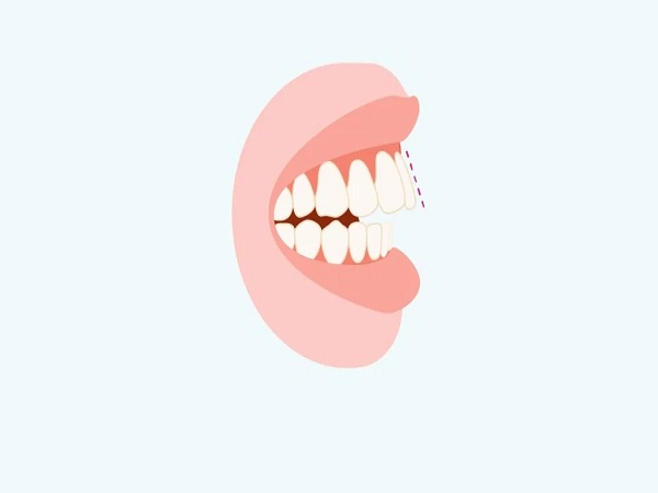 Hệ quả của răng hô - Ảnh 2