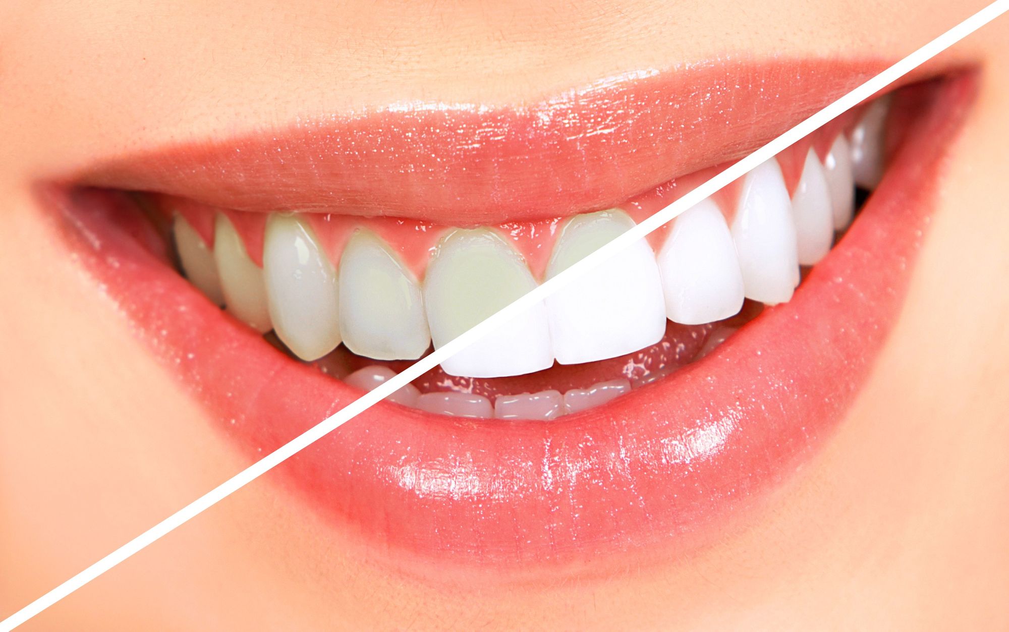 TOP 7 Cách tẩy trắng răng siêu hiệu quả bạn không nên bỏ lỡ