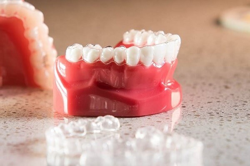 Những điều cần cân nhắc khi chỉ niềng răng hàm dưới hoặc trên - ẢNh 5