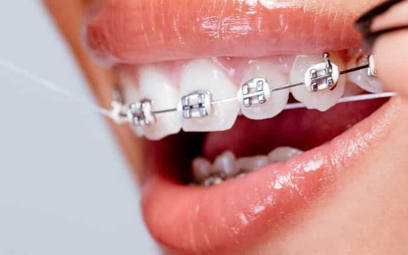 Cách chăm sóc răng miệng khi niềng răng: Đánh răng & dùng chỉ nha khoa - Ảnh 1